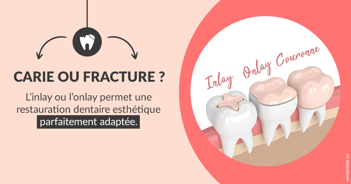 https://dr-ohana-gabriel.chirurgiens-dentistes.fr/T2 2023 - Carie ou fracture 2