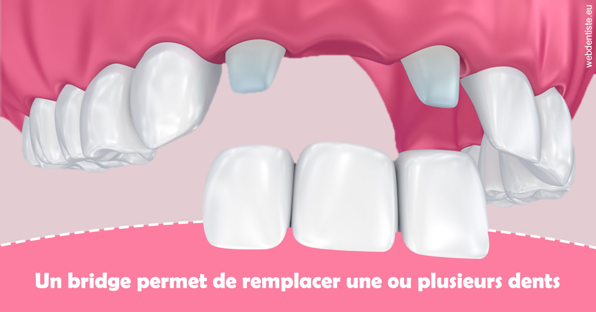 https://dr-ohana-gabriel.chirurgiens-dentistes.fr/Bridge remplacer dents 2
