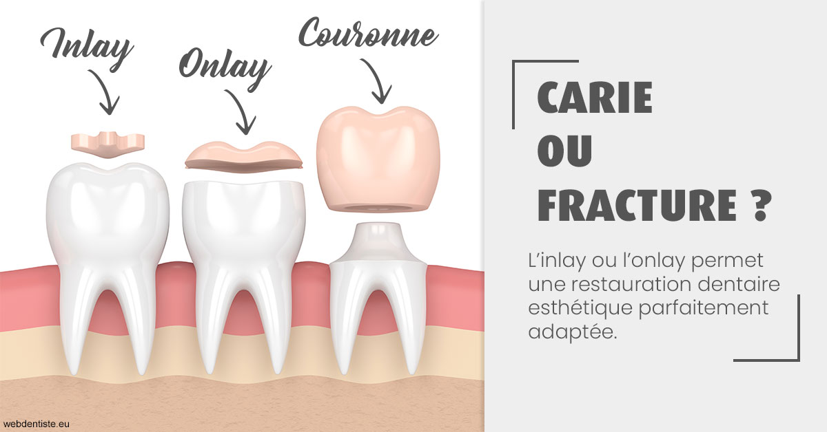 https://dr-ohana-gabriel.chirurgiens-dentistes.fr/T2 2023 - Carie ou fracture 1