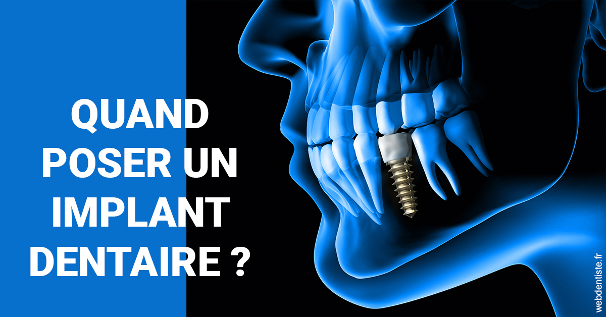 https://dr-ohana-gabriel.chirurgiens-dentistes.fr/Les implants 1