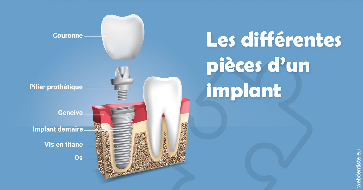 https://dr-ohana-gabriel.chirurgiens-dentistes.fr/Les différentes pièces d’un implant 1