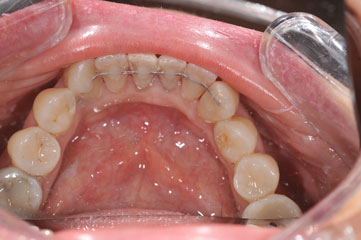 cas-10-alignement-dents-ap1