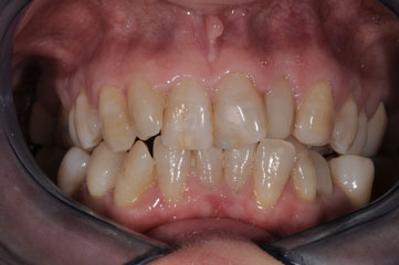cas-10-alignement-dents-av3