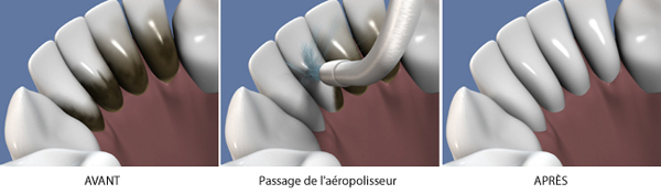 2.04_aeropolisseur