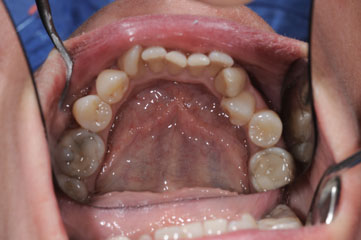 cas-10-alignement-dents-av1