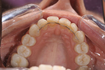 cas-10-alignement-dents-ap2