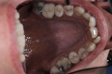 cas-10-alignement-dents-av2