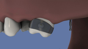 Implant orthodontique : redressement d'une molaire